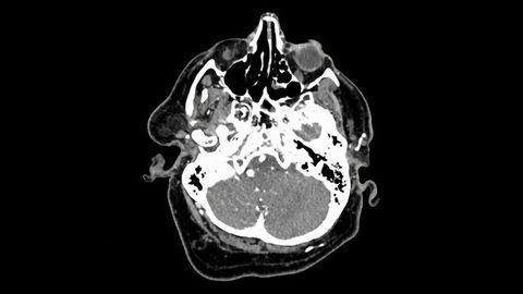 Brain Aneurysm Detection Aided by AI