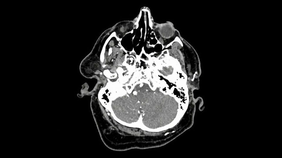 Brain Aneurysm Detection Aided by AI content piece image