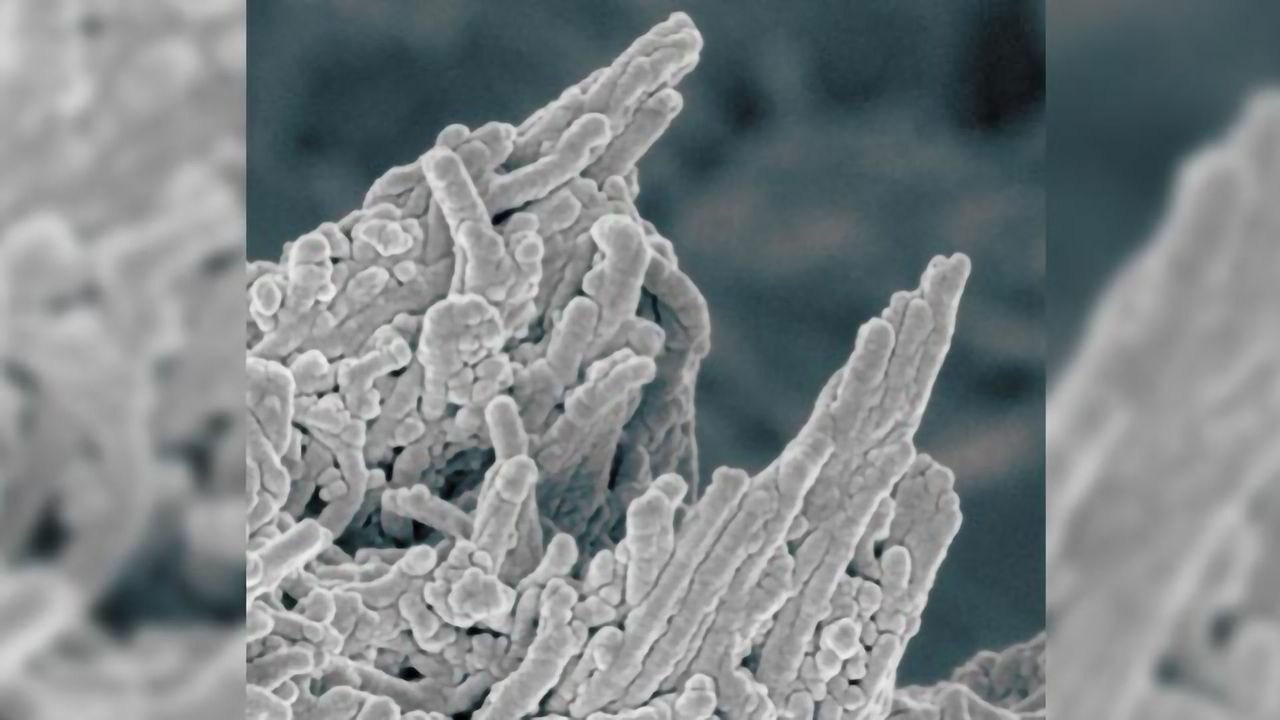 Acne Drug Could Help Combat Hardening of the Arteries