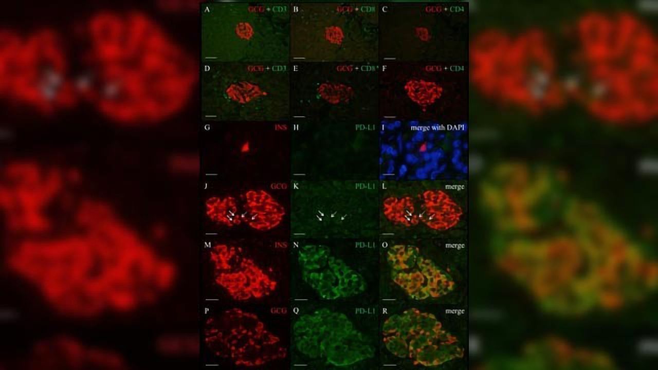 Immunotherapy and Diabetes – A Step Towards Understanding the Link
