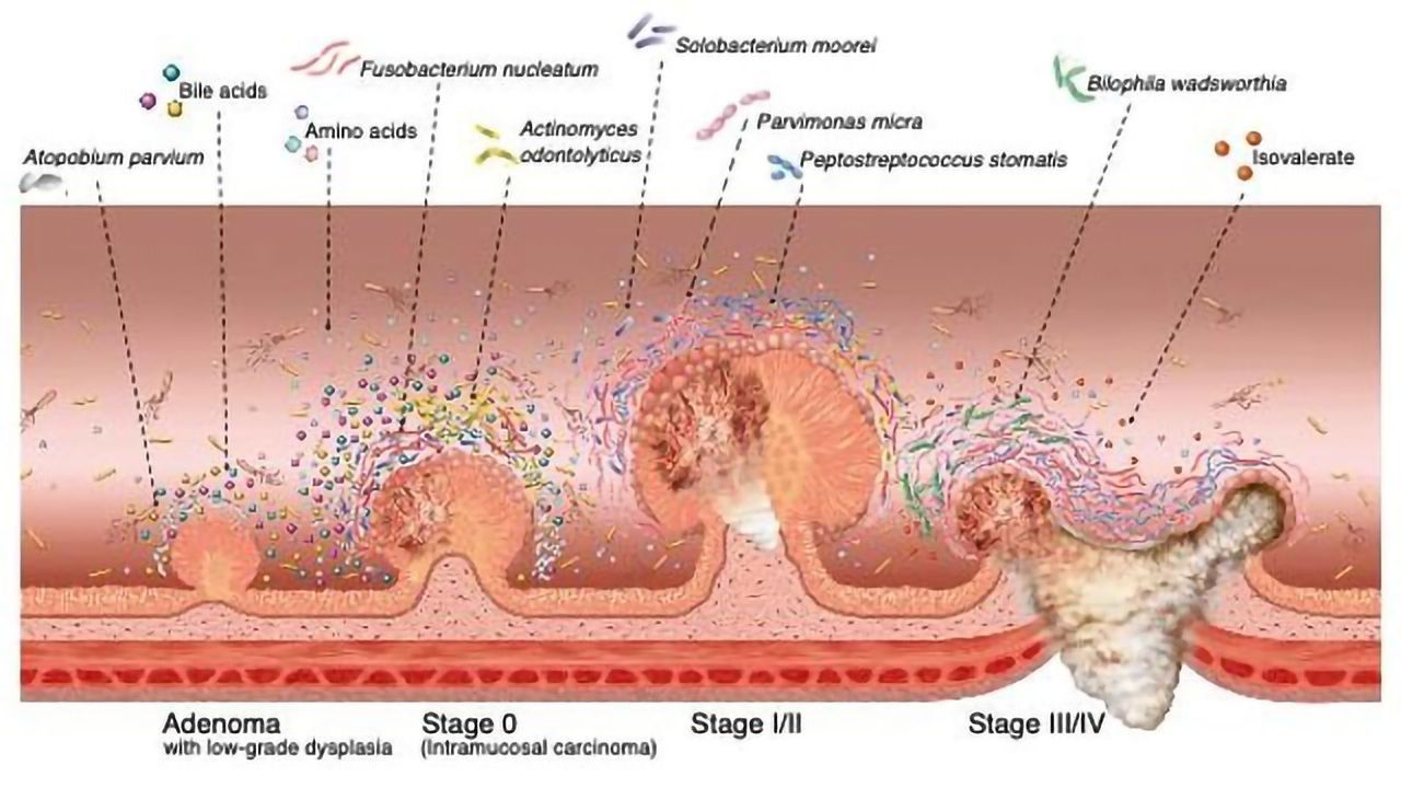 A Gut Feeling: Microbiome Changes Could Help Early Detection of Colorectal Cancer