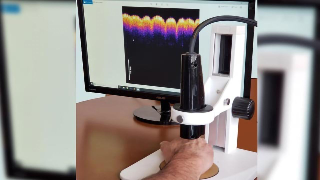 “Virtual Biopsy” Device Developed to Detect Skin Tumors
