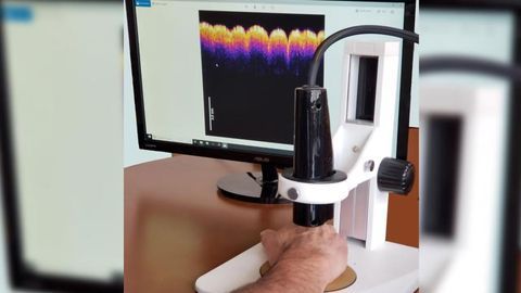 “Virtual Biopsy” Device Developed to Detect Skin Tumors