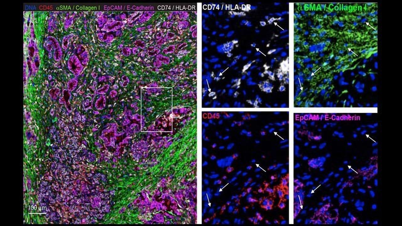 Fibroblasts Help Pancreatic Cancer Cells Evade Detection