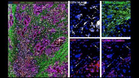Fibroblasts Help Pancreatic Cancer Cells Evade Detection