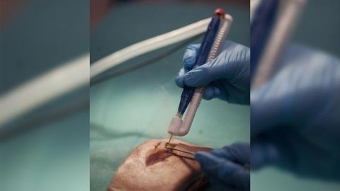 Artificial Nose Helps Neurosurgeons Identify Cancerous Tissue During Surgery