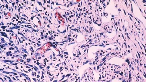 Cancer-killing Virus Gives Immunotherapy a Helping Hand Tackling Hard-to-treat Cancer