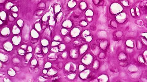 Drug Boosts Bone Growth in Children With Dwarfism in Four-year Study