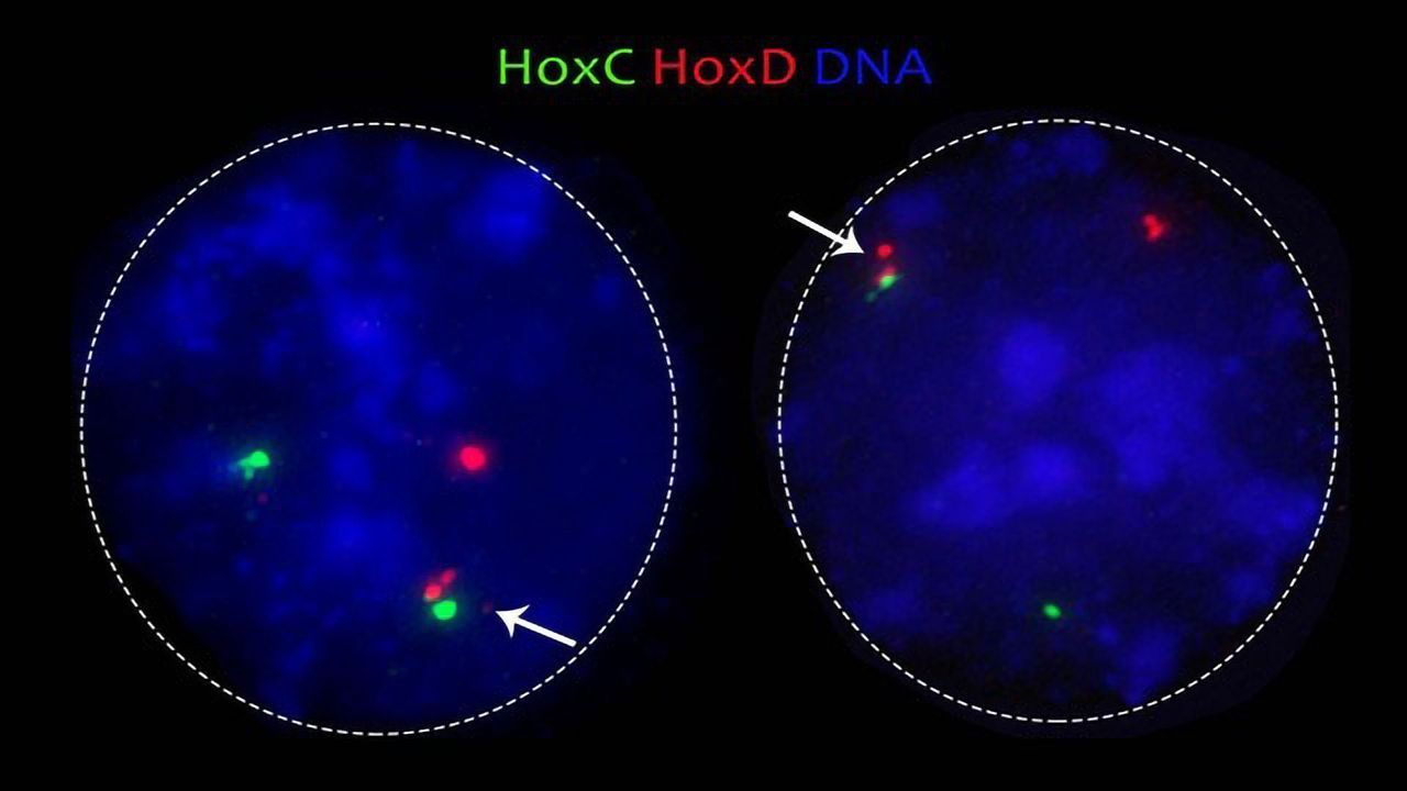 A New Role for Cohesin Protein in Tumors and Rare Diseases?