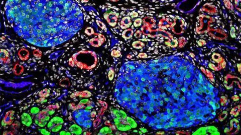 A Sweet Surprise: Targeting Sugar-coated Proteins to Treat Pancreatitis