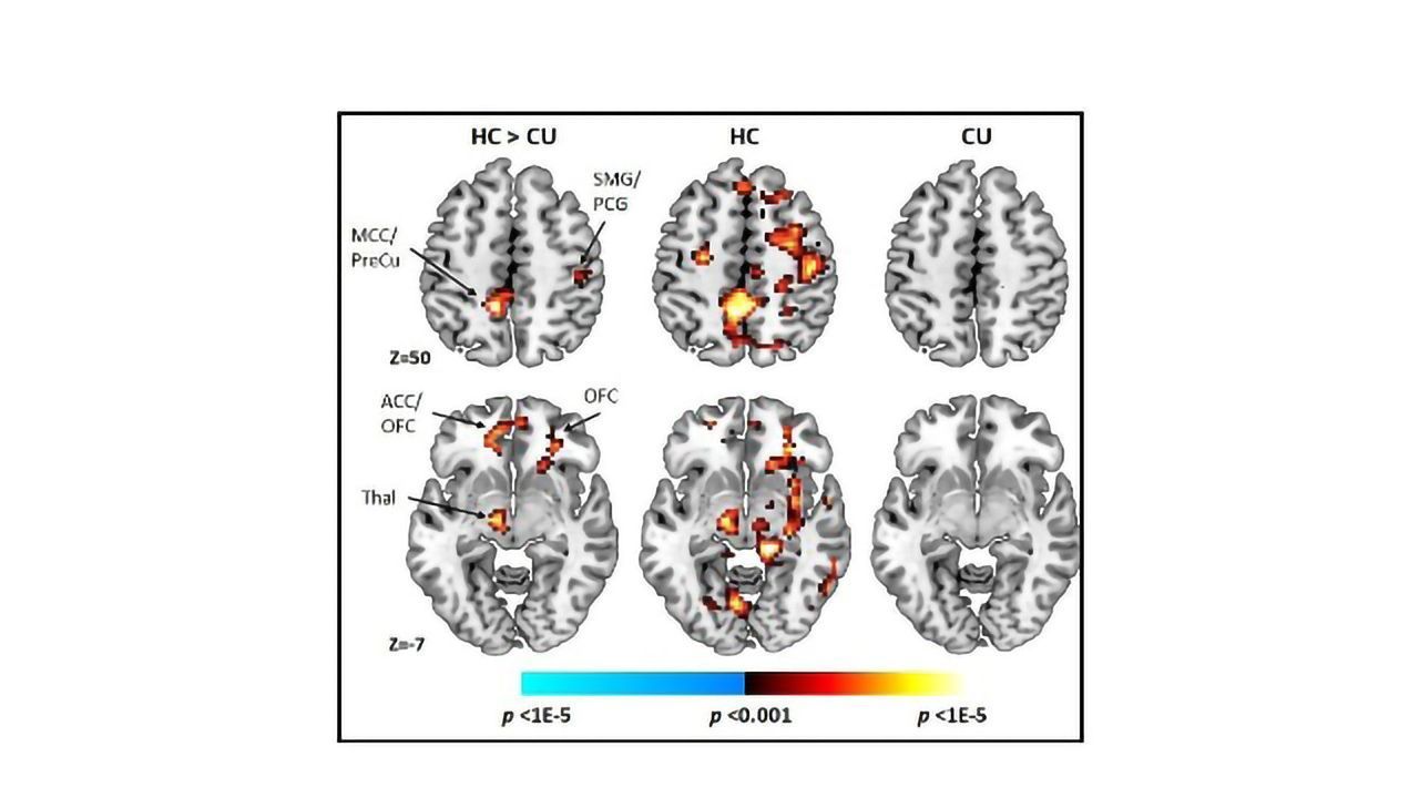 Cannabis Use Associates With Altered Cognitive Control
