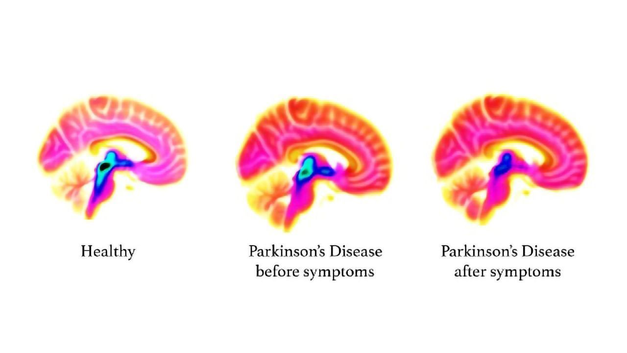 Serotonin System Malfunction Could Be an Early Warning for Parkinson's