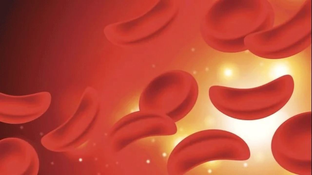 Sickle Cell Disease Monitored by Microfluidic Electrical Impedance Sensor