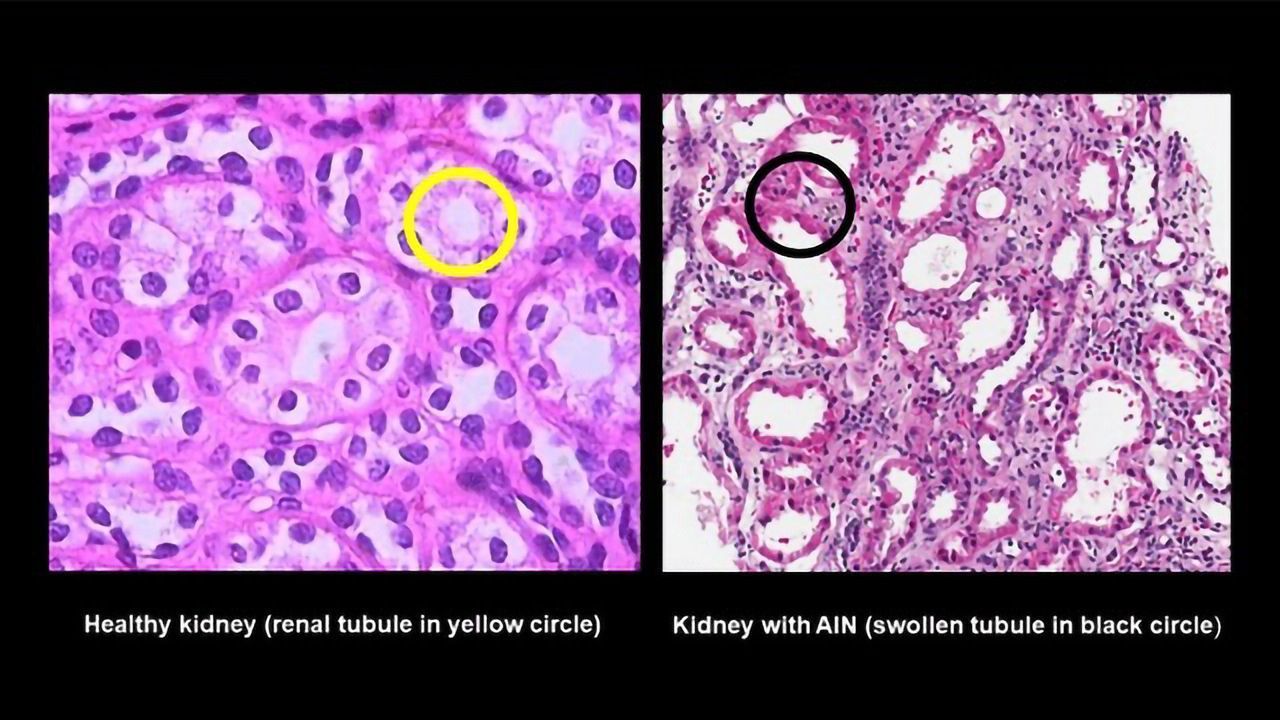 Urine Biomarkers Could Improve Diagnosis of Serious Kidney Allergic Reaction