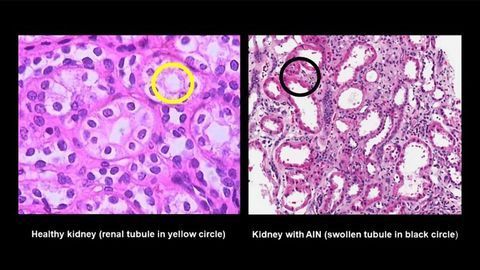 Urine Biomarkers Could Improve Diagnosis of Serious Kidney Allergic Reaction
