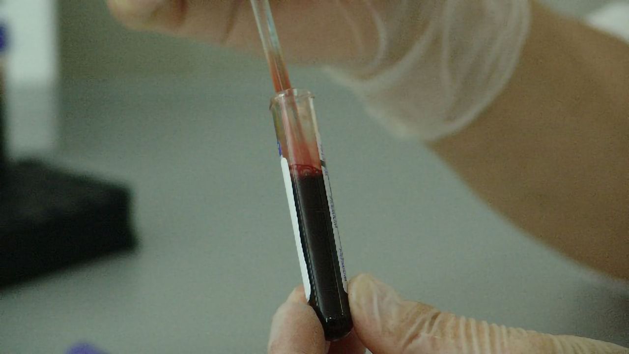 New Alzheimer's Blood Test to Start Clinical Study in Autumn