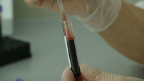 New Alzheimer's Blood Test to Start Clinical Study in Autumn