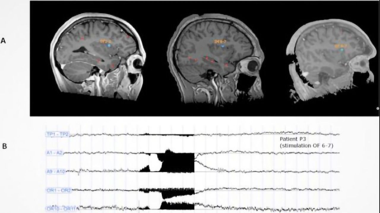 Does Stimulation of the Brain's Dorsal Anterior Insula Trigger Ecstasy?