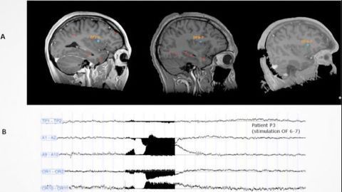 Does Stimulation of the Brain's Dorsal Anterior Insula Trigger Ecstasy?