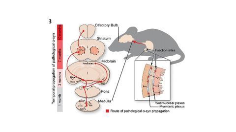 Parkinson's Could Begin in the Gut and Travel Via the Vagus Nerve