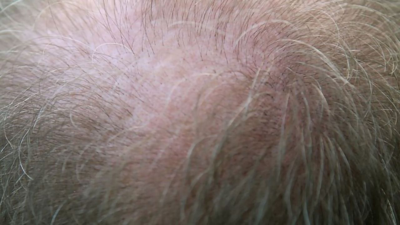 Stem Cells Used to Grow Hair