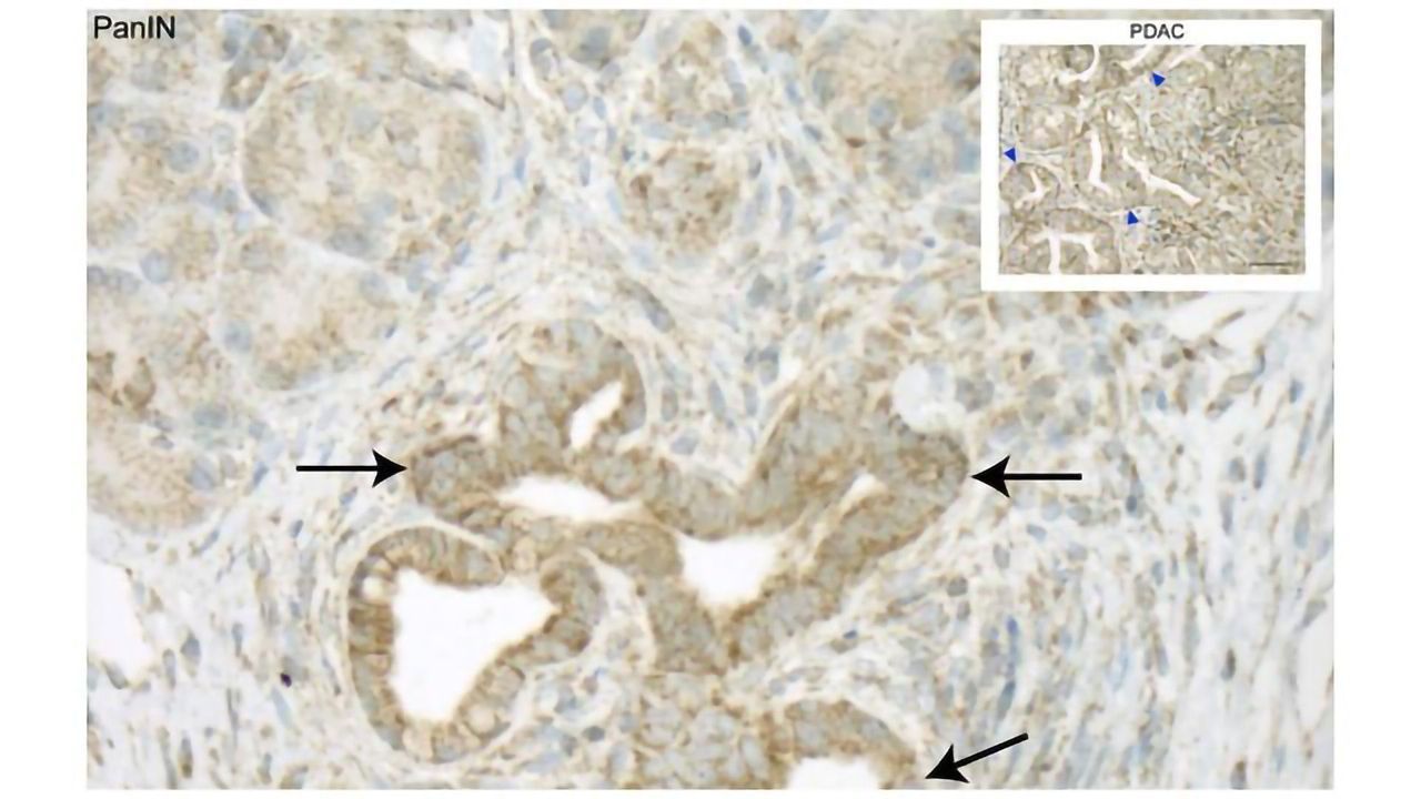 Cancer Cells’ “Self-eating” Could Be Novel Drug Target