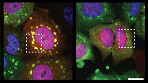 Protein “Clumps” May Offer Novel Treatment Avenue for ALS