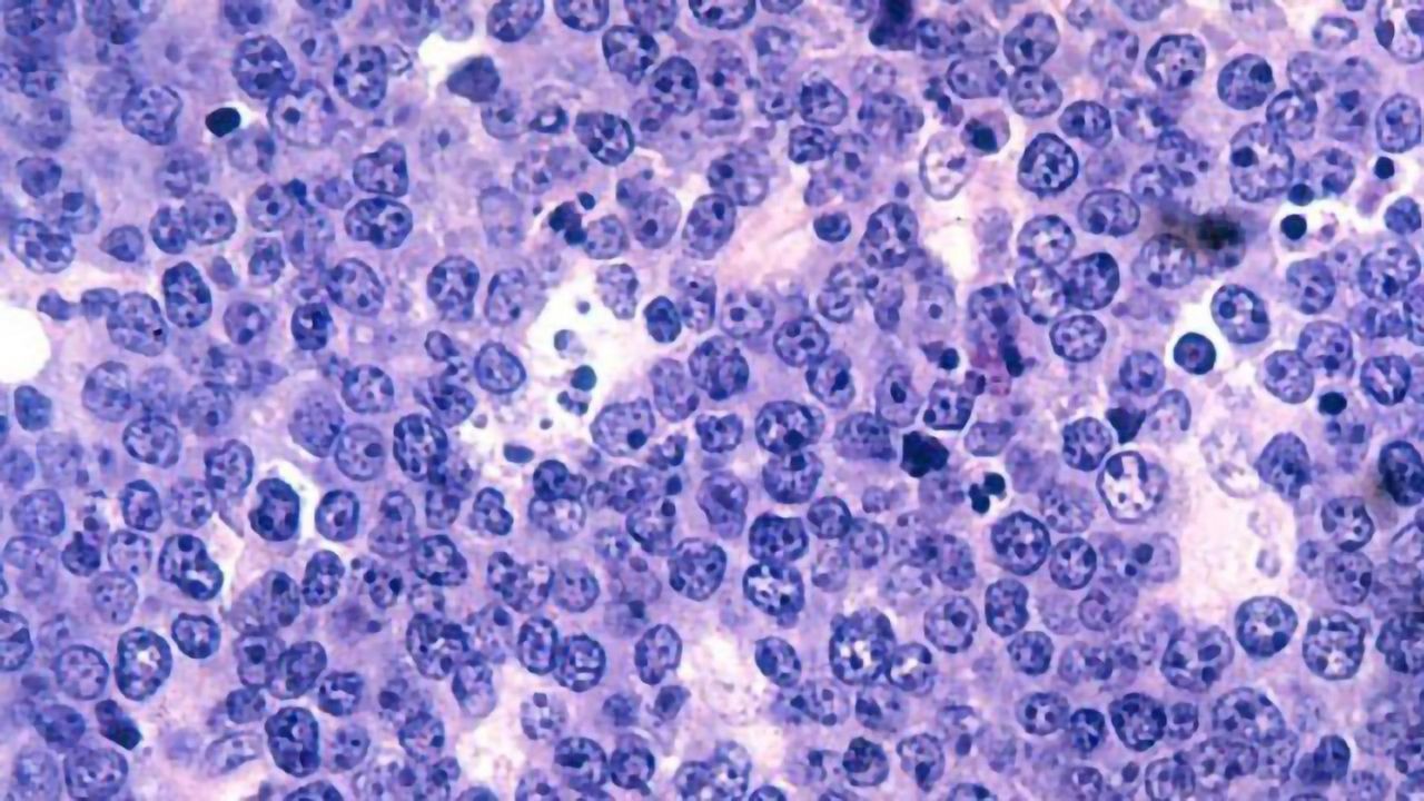 High Doses of Chemotherapy Drug Spurs Immune System to Attack Lymphoma