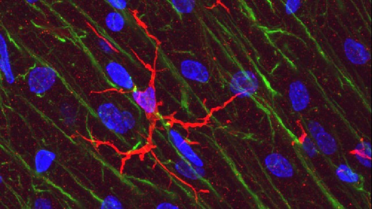 Microglia Linked to Brain Atrophy in Progressive MS