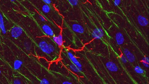 Microglia Linked to Brain Atrophy in Progressive MS