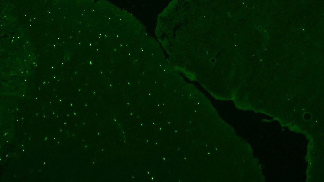 Newfound Autoimmune Disease Targets Men With Testicular Cancer