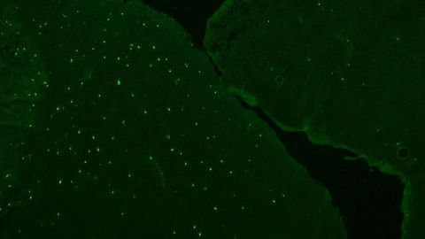 Newfound Autoimmune Disease Targets Men With Testicular Cancer