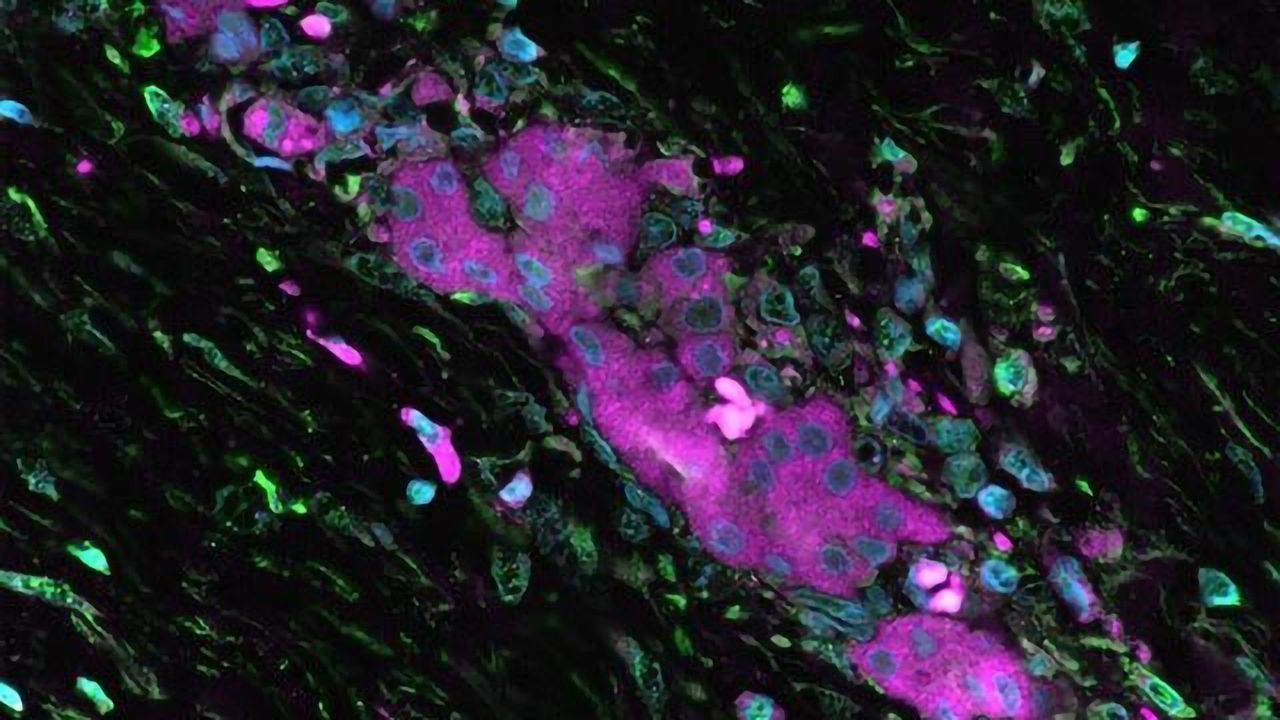 Treatment Target Found for Liver Cancer in Young Adults