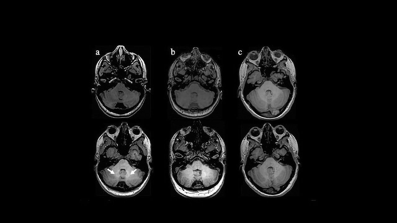 Gadolinium Deposition Found in Early MS Brains