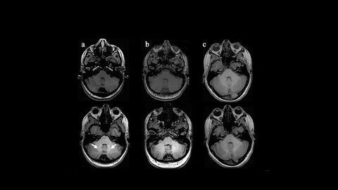 Gadolinium Deposition Found in Early MS Brains