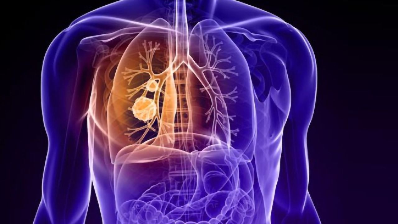 Investigators Identify Potential Lung Cancer Markers
