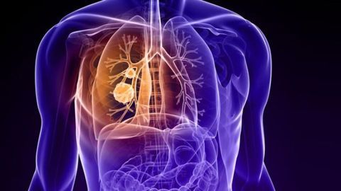 Investigators Identify Potential Lung Cancer Markers