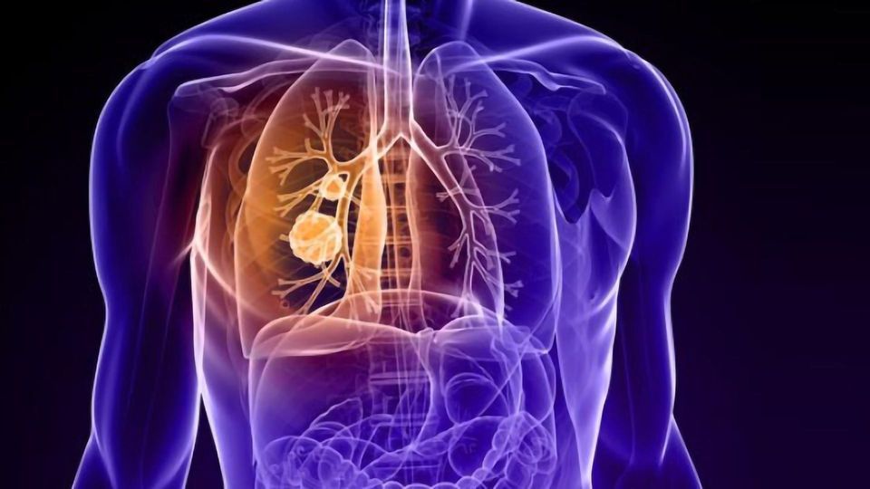 Investigators Identify Potential Lung Cancer Markers content piece image