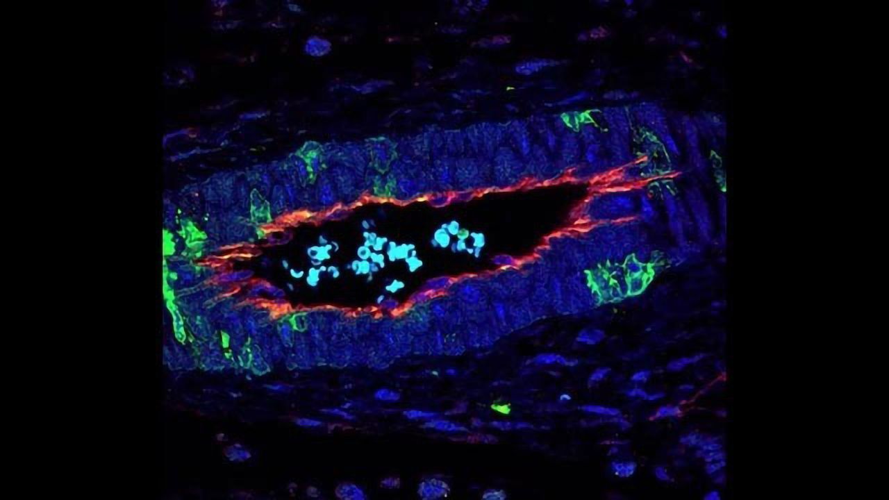 p38 Protein Regulates Angiogenesis in Colon Cancer