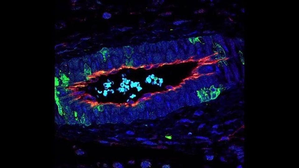 p38 Protein Regulates Angiogenesis in Colon Cancer content piece image