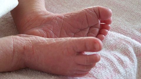 Preventing Eczema Skin Cracks Could Reduce Allergy Issues