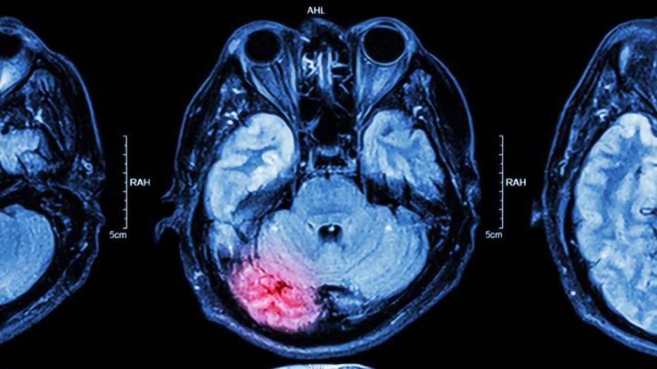 Removing Newborn Neurons Cuts Mouse Seizures