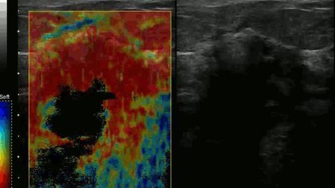 Algorithms Could Make Breast Cancer Diagnosis Easier