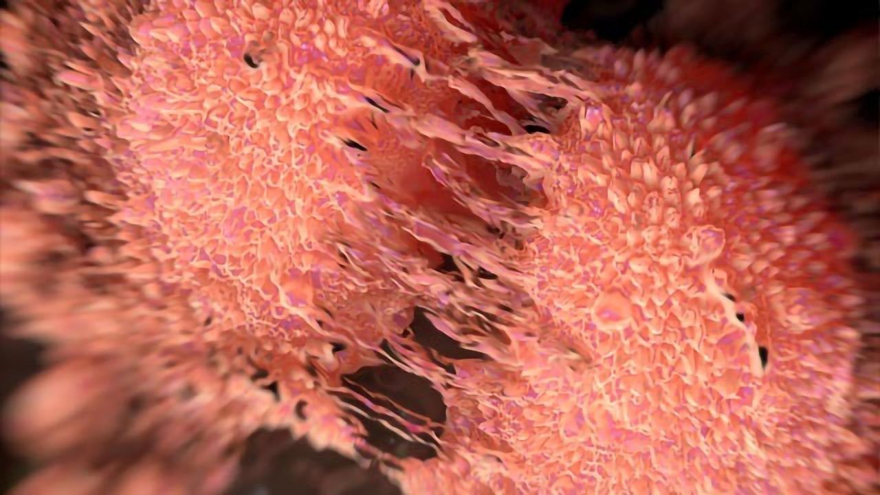Fat Cells Play Role in Fatal Transformation of Melanoma