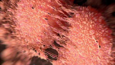 Fat Cells Play Role in Fatal Transformation of Melanoma