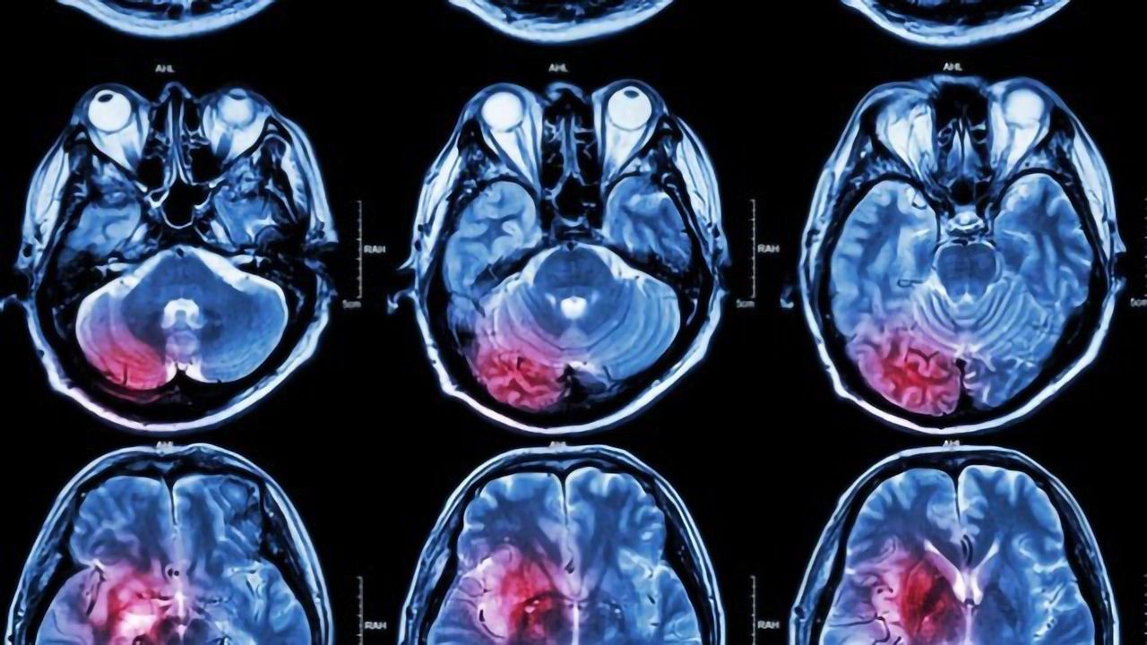 Treatment Takes a "BiTE" Out of Brain Cancer