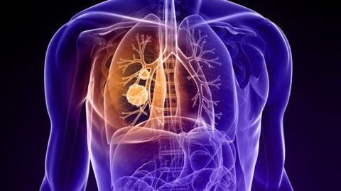 Two Drug Targets Discovered for Deadly Lung Cancer