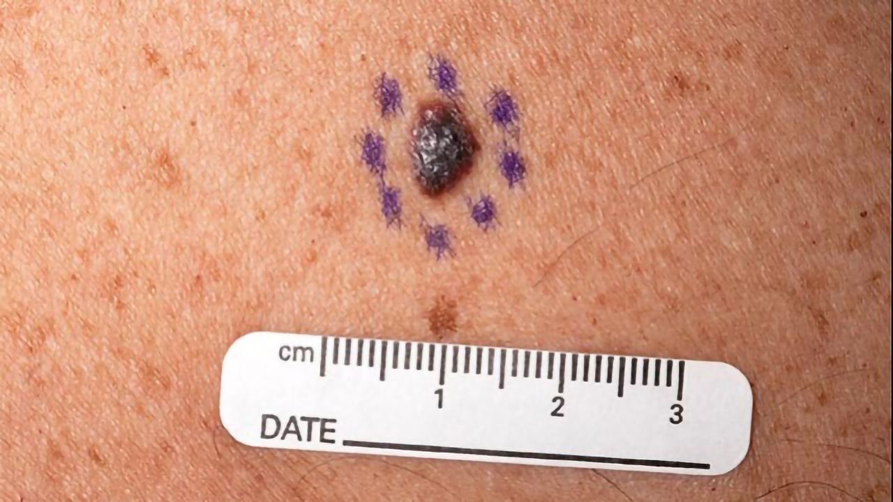 Skin Cancer Rates Have Soared by 45% Since 2004