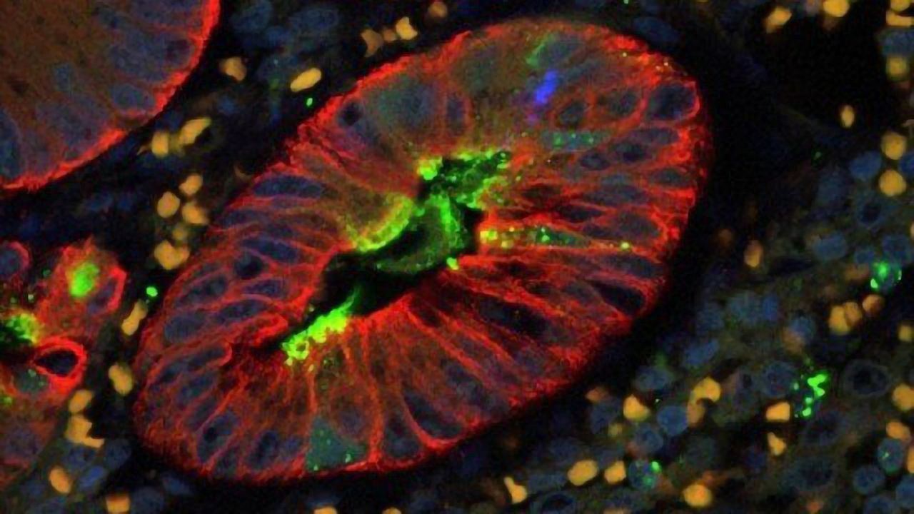 Human Appendix Infected With the Measles Virus