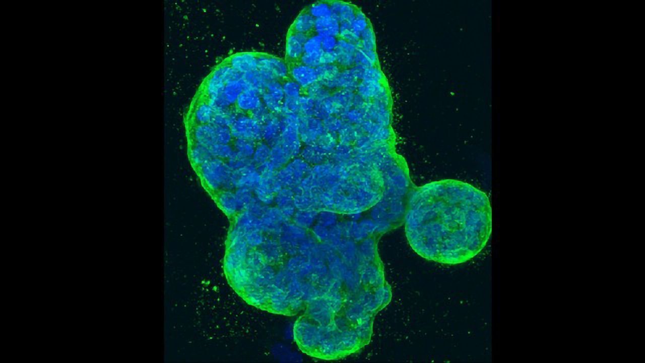 Breast Cancer in a Dish